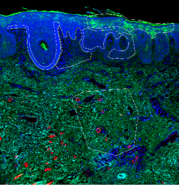 vulvar skin spatial transcriptomics